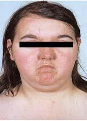 Cushing yndrome Hyperfunction (Cushing): obesity, fat redistribution,