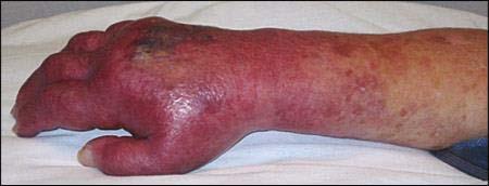 Infiltration Scale Grade Clinical Criteria 0 No symptoms 1 Skin blanched, Edema <2.