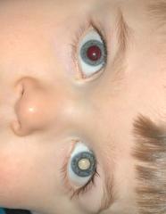 having retinoblastoma, a complete eye and systemic examination is required.