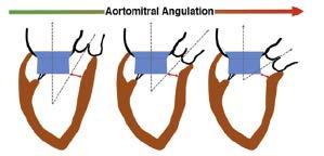 LVOT obstruction and aorto- mitral angle AoV Aorto- Mitral Angle Blanke P. et al.: JACC Cardiovasc Imaging.