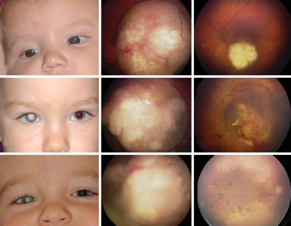 A B C D E F G H I Figure 1. Complete response from intra-arterial chemotherapy for retinoblastoma.