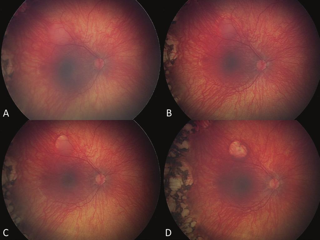 Figure 1. Unilateral multifocal retinoblastoma in the left eye of a boy with minimally pigmented fundus. (A) Before treatment, the viable retinoblastomas are noted.