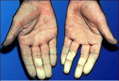 Adverse Conditions to Cryotherapy hypothermia frostbite cold allergies Raynaud's phenomenon