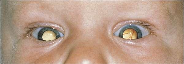Clinical Manifestations The most common presenting manifestation of retinoblastoma is a white glow in