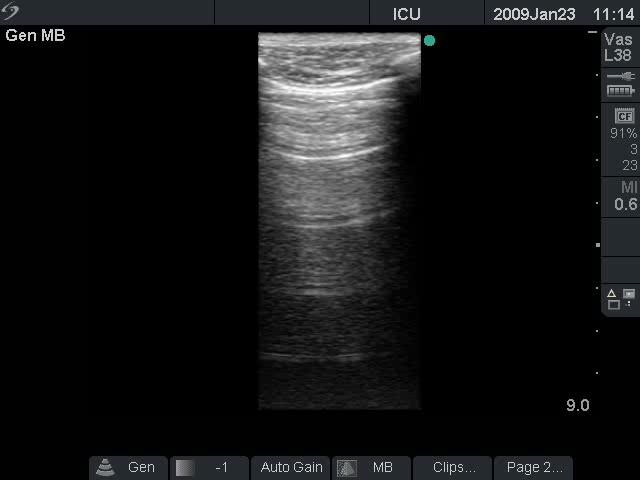 Sonographic examination of the lung Normal aeration A-lines Clinical utility of A-lines The presence of A-line pattern with