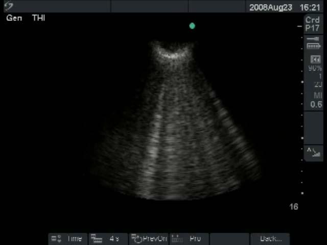 Sonographic examination of the lung Alveolar
