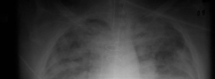 Sonographic examination of the lung Alveolar interstitial pattern To be
