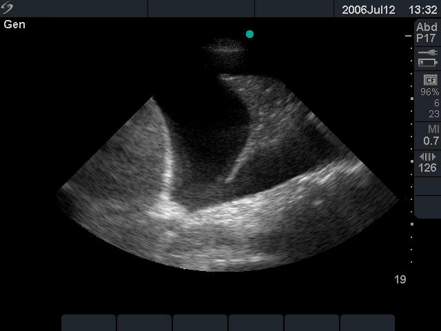 Assessment of the pleural space for effusion Ultrasonographic diagnosis Simple effusion Typically are anechoic (echo-free)