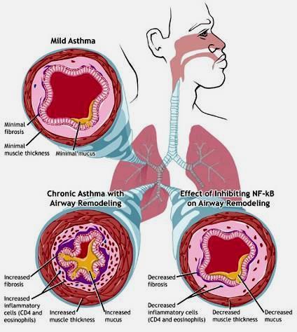Pathogenesis of Asthma - Chronic Changes Airflow limitation Chronic mucus plug formation persistent airflow limitation in