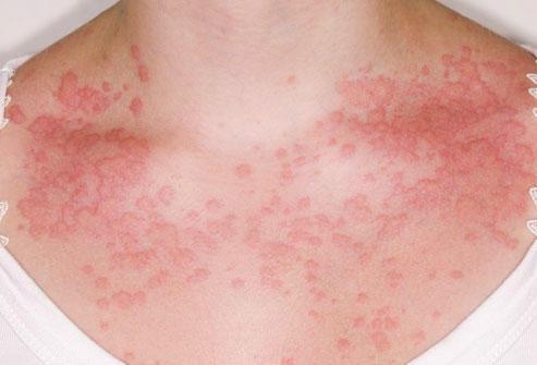 hives, swelling of the lips, eyes or face, vomiting or wheeze.