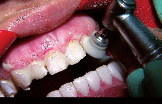 1. Polishing Clean the teeth with