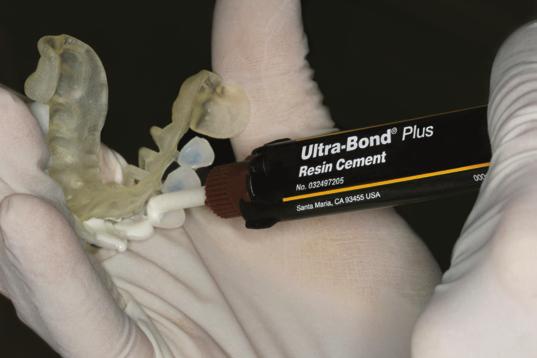 8. Ultra-Bond Plus on LUMINEERS 1. Add an even layer of Ultra-Bond Plus resin cement to the inner side of the LUMINEERS.