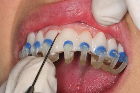 Remove more excess cement with a probe. 3. Light-cure each tooth for 3 seconds through the tray with Sapphire.