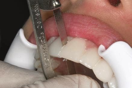 12. Clean-Up and Open Interdental Spaces 1.