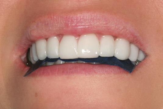 14. Check Occlusion and Polish 1. Check and finish the occlusion.