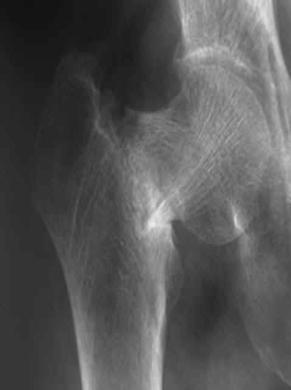 deterioration of bone tissue with a consequent increase