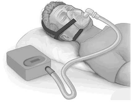 APNEA/HYPOPNEA INDEX (AHI) FOR OSA Mild: AHI of 5-15 events per hour Moderate: AHI of 15-30 events per hour Severe: AHI of greater than 30 events per hour OSA TREATMENT PAP/CPAP for moderate to