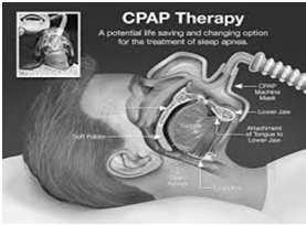 CPAP Pressurized room air