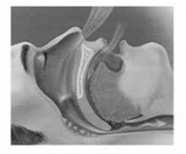 Obstructive Sleep Apnea Sleep Loss of airway tone Airway obstruction Hypoxia