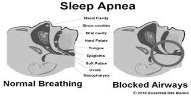 Fragmented sleep, hyper somnolence, impaired cognition Increased airway tone