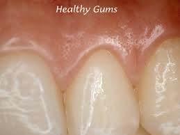 Healthy Gum Tissue Healthy gums are pale pink in color. They lay flat against the teeth.