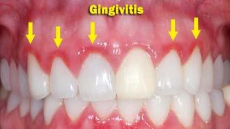 15 Gingivitis (Gum Inflammation) Unhealthy gums are red in color.