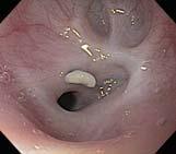 Anastomotic stricture Predisposing factors are anastomotic tension, anastomotic leakage, and presence of GER Previous studies have shown a clear correlation