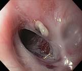 Dilatation Gastroesophageal Reflux & Peptic Esophagitis Reflux is almost universal after EA repair About 50% of patients may be weaned of antireflux treatment