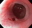 Anastomotic stricture and