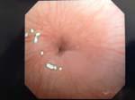 Tracheobronchial Remnant Congenital Esophageal Stenosis CES associated with EA is