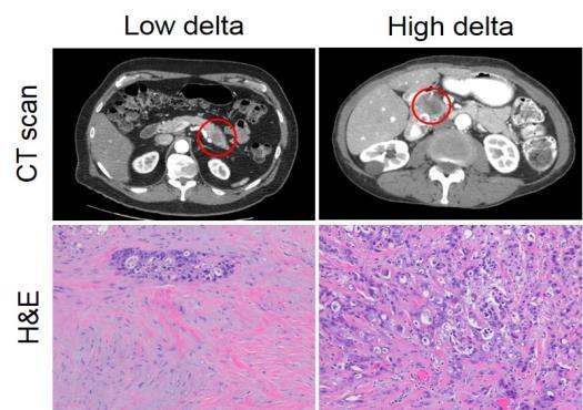 Association of stroma and delta measurement High delta tumors have lower stroma content.