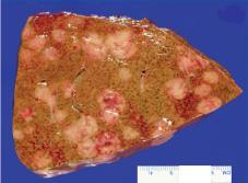 A) Pancreas specimen from pt with locally advanced disease.