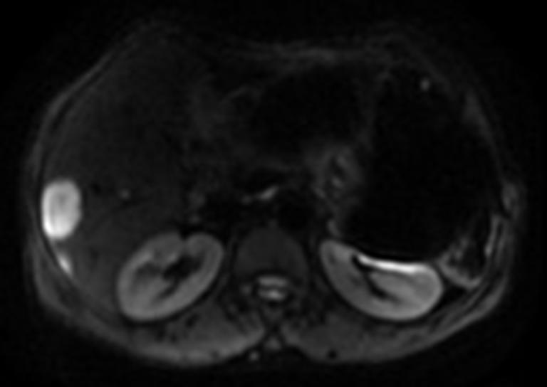 neuroendocrine tumors of the pancreas was made; then, resection and radiofrequency ablation of the multiple metastatic tumors