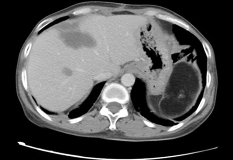 Localized thickening of the pleura was seen in both sides. No pleural or pericardial effusion was found. The abdominal cavity showed postoperative changes.