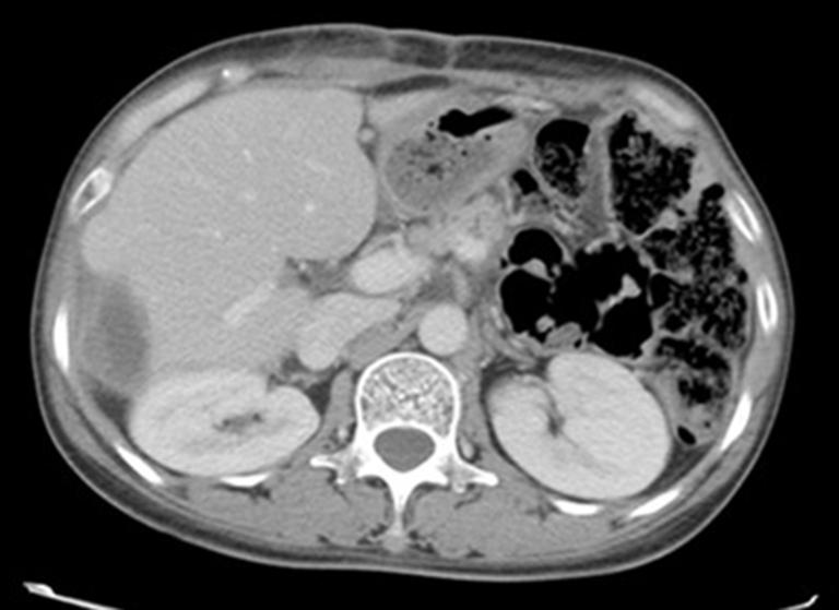 new low-density area was seen in the original site of liver metastatic tumor and was considered to be a postoperative D change (Figure 6).