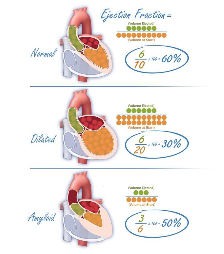 Notice that the dilated heart with an ejection fraction of 30% pumps as much blood around as the normal heart.