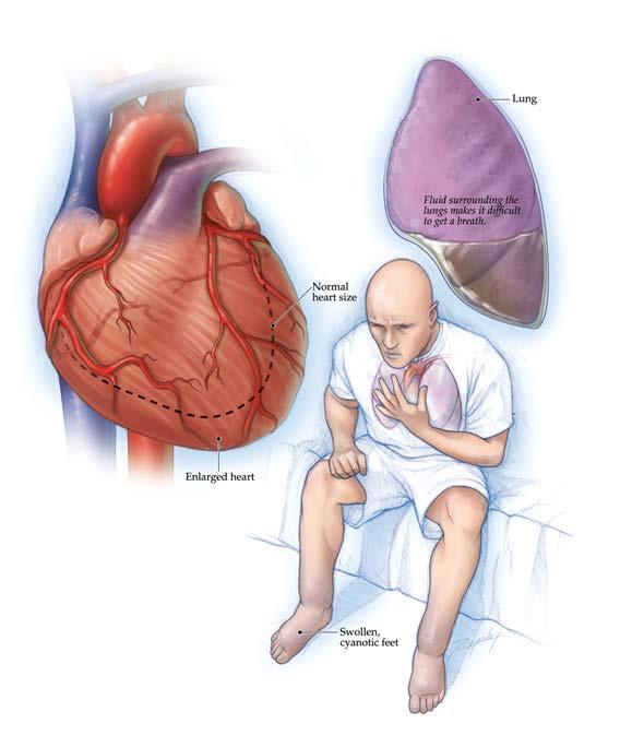 Symptoms and Signs of Heart Failure Fatigue Shortness of Breath Swelling (edema) Unable to lie down
