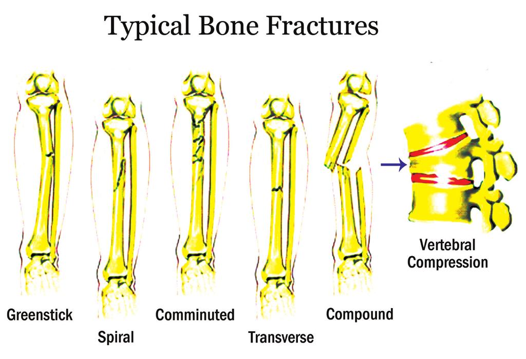 Medial epicondyle rounded projection of the bone posterior to the condyle which serves as a place of attachment of ligaments. The medial epicondyle is on the medial side of the bone.