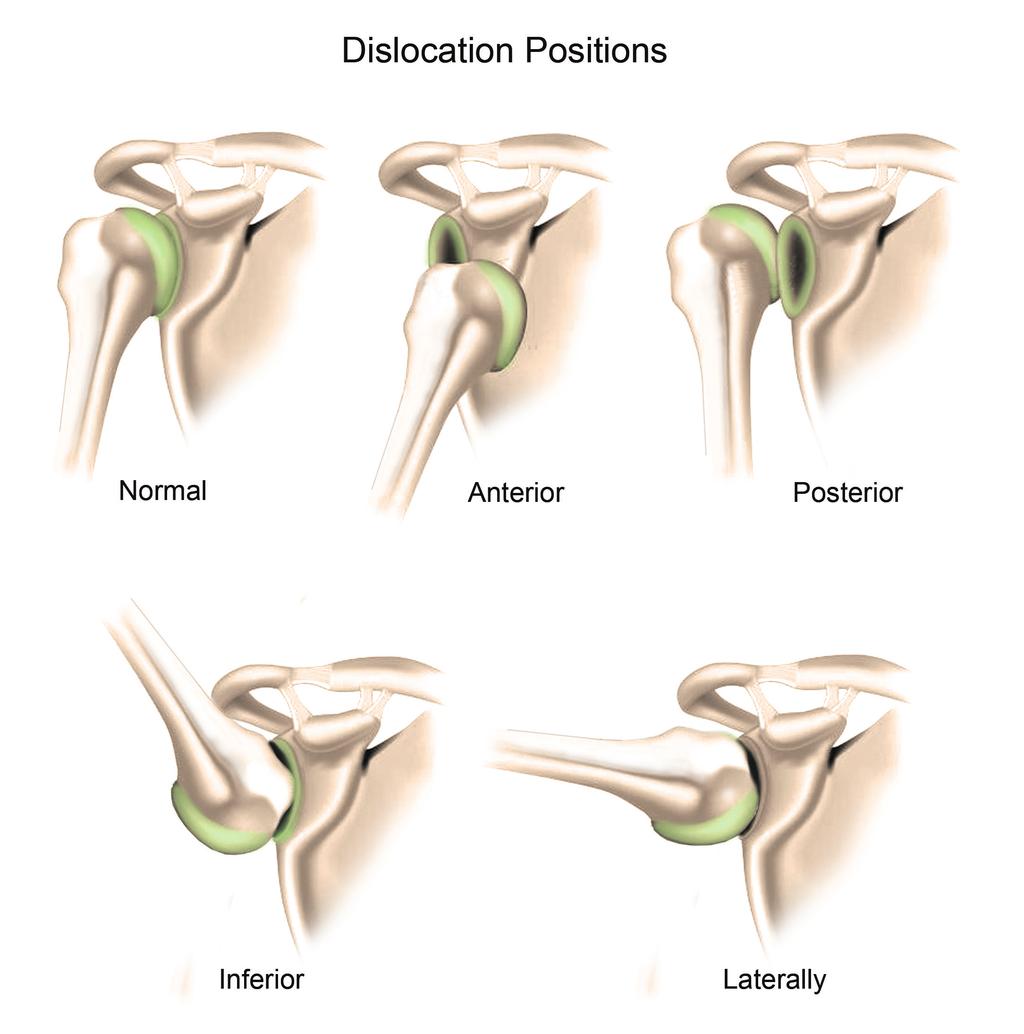 Percentage dislocations of certain joints are further classified by the extent based upon percentage of the dislocation.