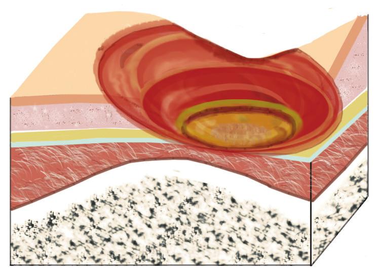 The damage may extend beyond the primary wound below layers of healthy skin. Source: AAPC Stage IV A stage IV ulcer exhibits large-scale loss of tissue: The wound may expose muscle, bone and tendons.
