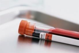 Your doctor can test your blood for HIV.