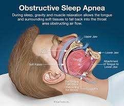 While asleep, upper airway obstructs