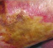 In one case study Flaminal products were used, and two months of daily treatment the wound reduced by 1cm 2 comparative study on partial-thickness hand burns (Kyriopoulos et al, 2010), patients with