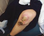 Product Clinical REVIEW Figure 4: Full-thickness burn to the patient s knee treatment. Figure 5: The wound two weeks of daily dressings. Figure 6: The wound three weeks of daily dressings.