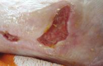 wounds were covered Figure 10: A venous leg ulcer Flaminal treatment.