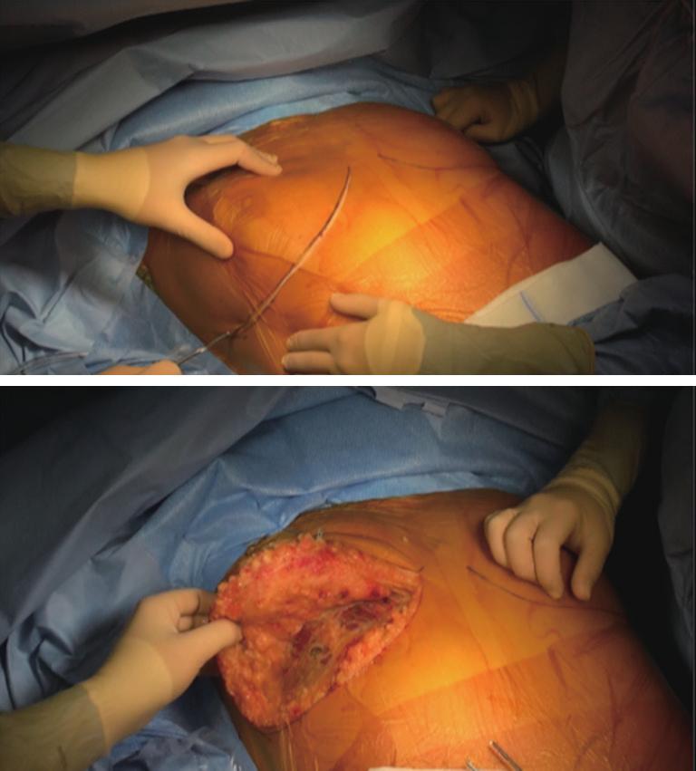 Journal of Thoracic Disease, 2018 3 A B Figure 4 Double anterior thoracotomy. (A) Cutaneous incision. The right side is opened first; (B) breast tissue is pulled upward. Figure 5 Lung dissection.