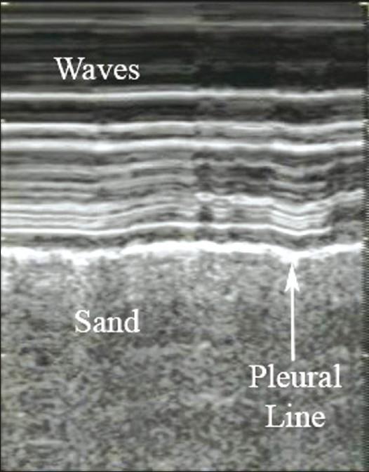 Dynamic Changes: The pleural line "slides" (to and fro movement) with respiration. This happens because the visceral pleura slides over the parietal pleura as the lung expands with inspiration.