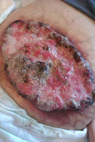 UVOD Slika 2. Klinička slika lokalno uznapredovalog planocelularnog karcinoma kože. Smatra se da se lokalne i udaljene metastaze pojavljuju u oko 5% -12% slučajeva (4-7).