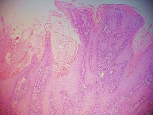 UVOD Slika 5. Patohistološka slika planocelularnog karcinoma kože (HE x40).