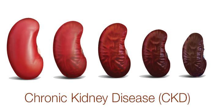 What is CKD Chronic kidney disease (CKD) is a long term health issue where the kidneys develop trouble doing many tasks they are responsible